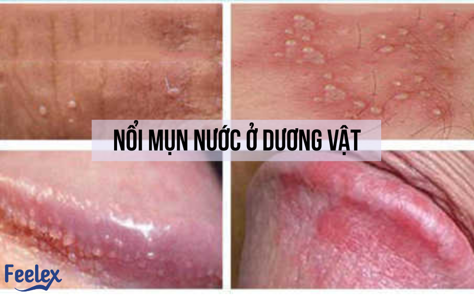 Nổi mụn nước ở dương vật