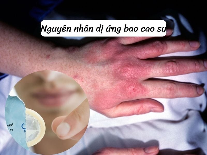 Nguyên nhân dị ứng bao cao su