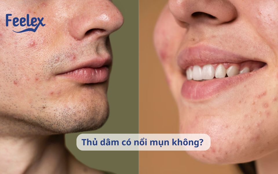 thủ dâm có nổi mụn không