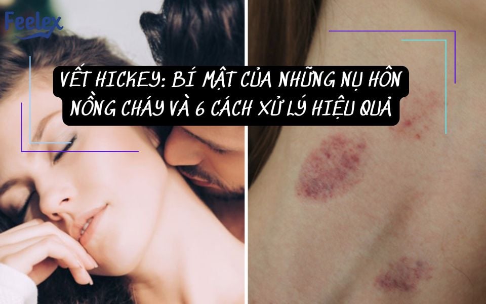 vết hickey