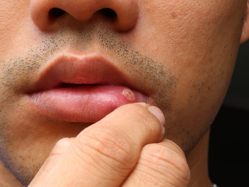 Miệng nổi mụn nước hoặc vết loét có thể là dấu hiệu Herpes miệng 