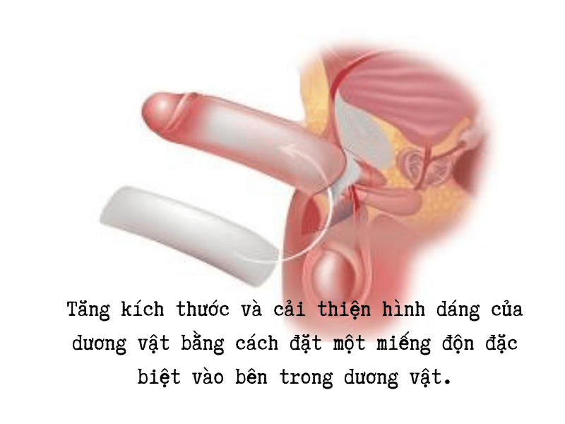 Mục đích của phẫu thuật độn dương vật