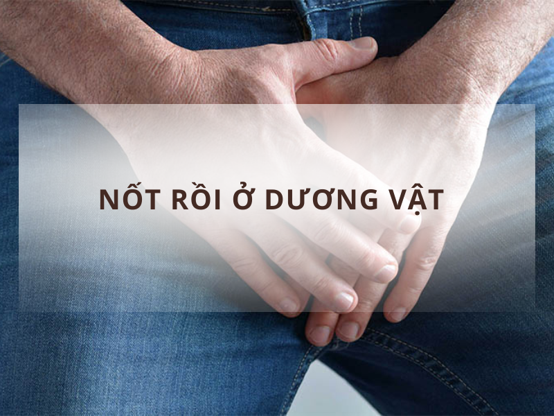 nốt ruồi ở dương vât nam