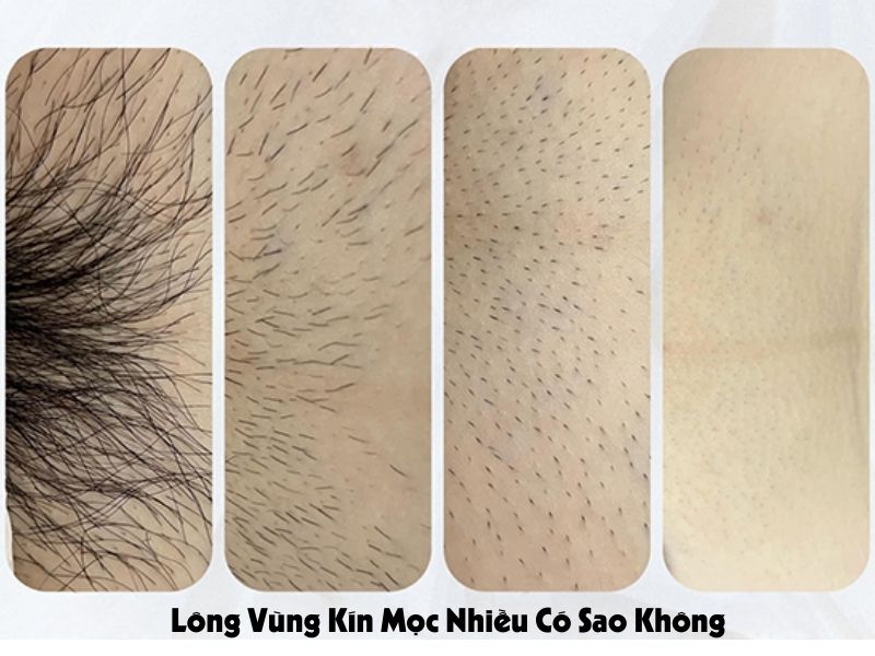 Vùng kín nhiều lông