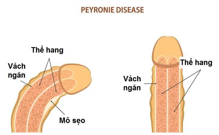 Dương vật cong hay thăng tốt hơn