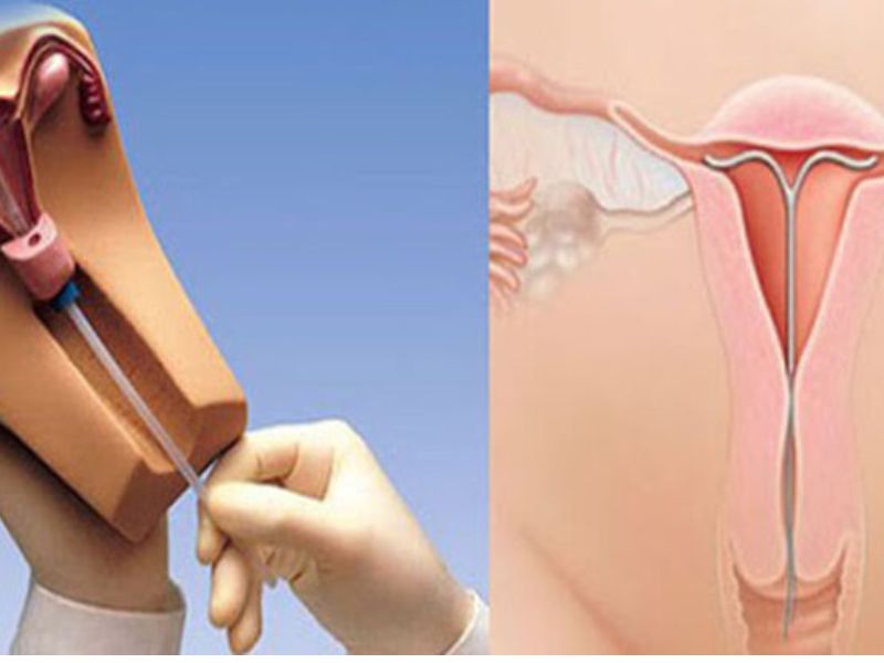 7 Tác Dụng Phụ Của Đặt Vòng Tránh Thai Chị Em Cần Biết Lam sao giam thieu tac dung phu cua vong tranh thai