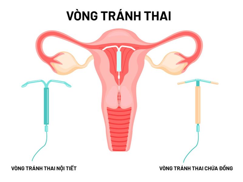  lưu ý sau khi đặt vòng chữ T