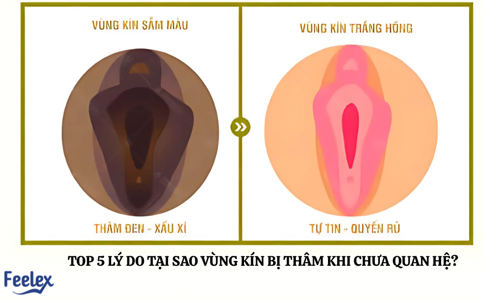 Tại Sao Vùng Kín Bị Thâm Khi Chưa Quan Hệ