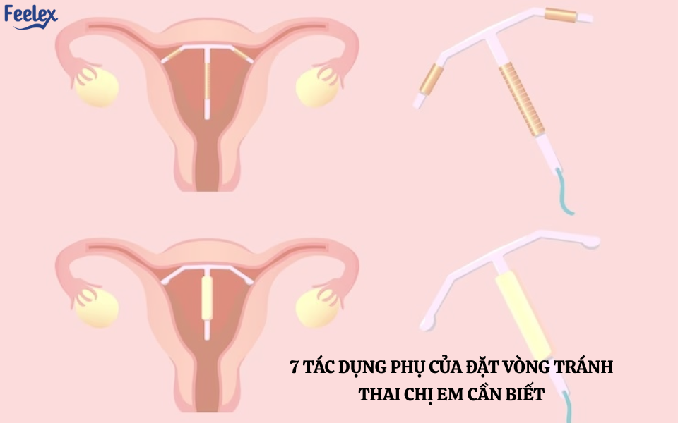 Tác Dụng Phụ Của Đặt Vòng Tránh Thai