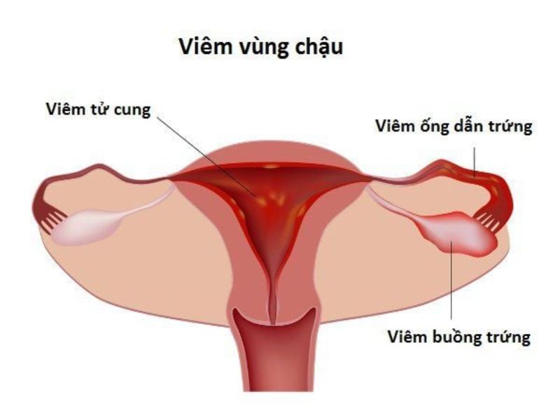 7 Tác Dụng Phụ Của Đặt Vòng Tránh Thai Chị Em Cần Biết Viem vung chau