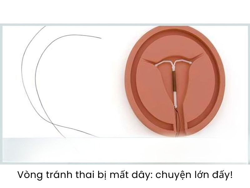 Vòng tránh thai bị mất dây