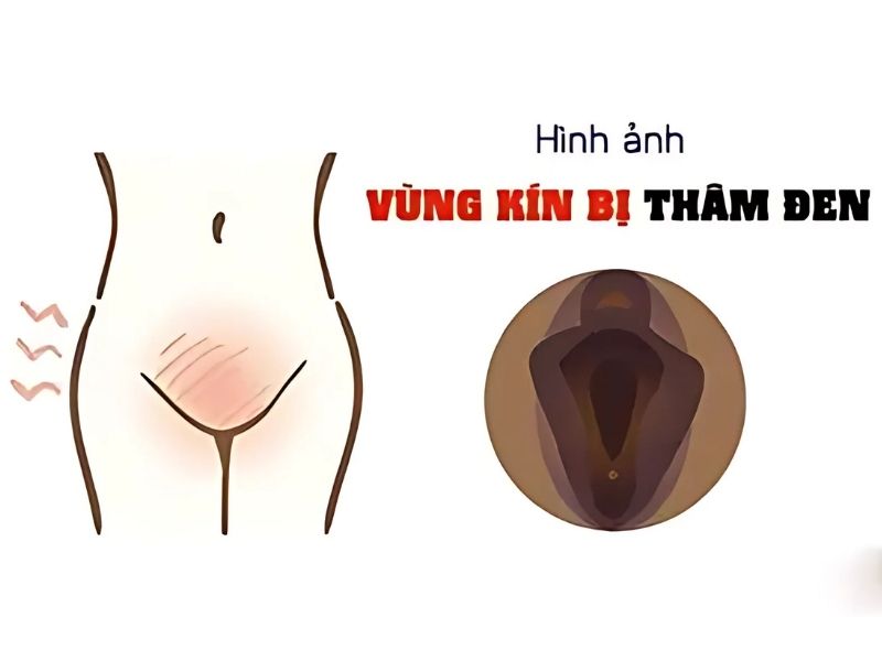 TOP 5 Lý Do Tại Sao Vùng Kín Bị Thâm Khi Chưa Quan Hệ? Vùng kín thâm khi chưa quan hệ