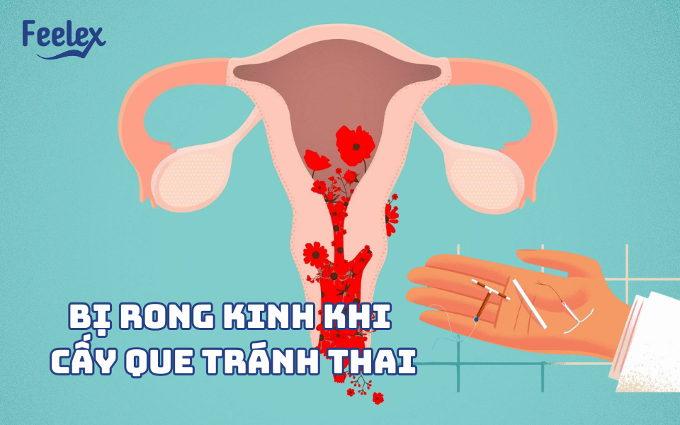 Bị rong kinh khi cấy que tránh thai