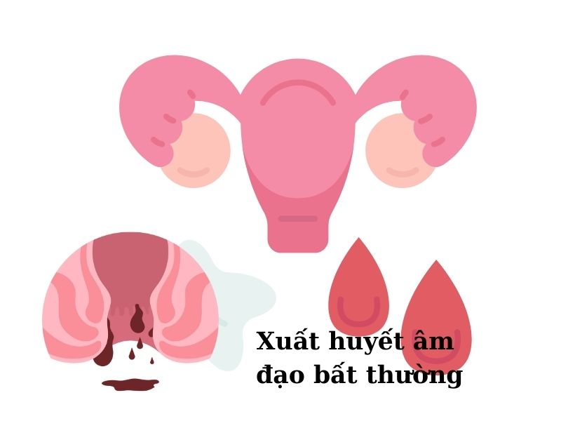 Những ai không nên đặt vòng tránh thai: 5 đối tượng “hàng đầu”! Phụ nữ có xuất huyết âm đạo bất thường, không nên đặt vòng tránh thai.