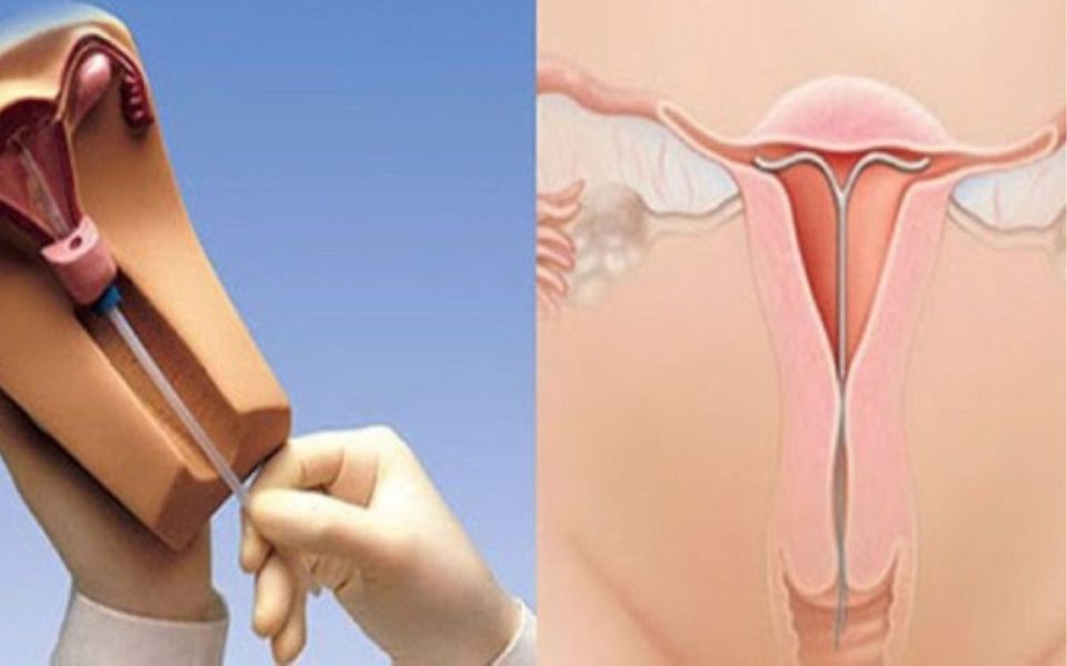 5 Sự Thật Về Đặt Vòng Tránh Thai Phụ Nữ Nên Biết Khi Quyết Định Cơ chế hoạt động của vòng tránh thai
