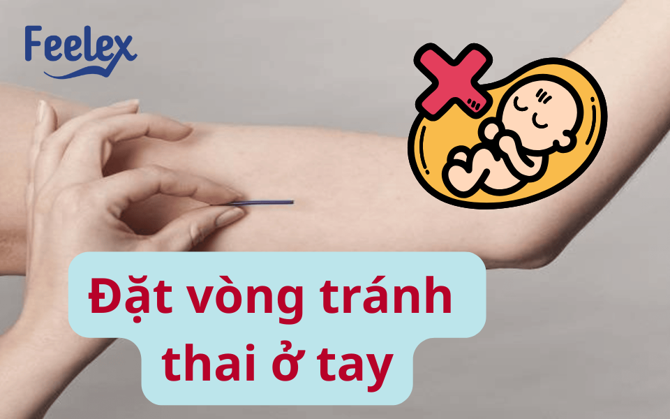 Đặt vòng tránh thai ở tay