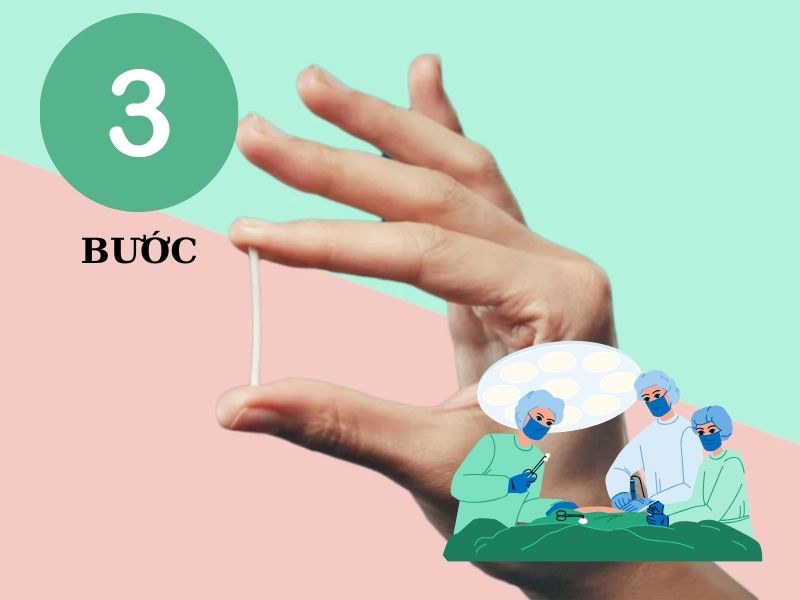 Tháo que tránh thai: TOP 5 điều hữu ích bạn cần biết ngay! Quy trình tháo que tránh thai đúng chuẩn