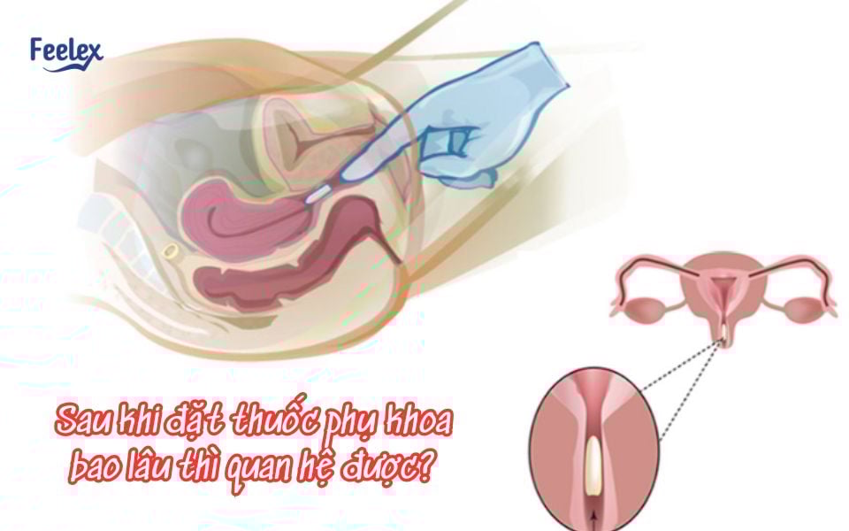 sau khi đặt thuốc phụ khoa bao lâu thì quan hệ được