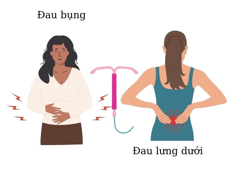 Cảnh báo TOP 5 dấu hiệu nhận biết khi tuột vòng tránh thai Biểu hiện bất thường sau đặt vòng tránh thai