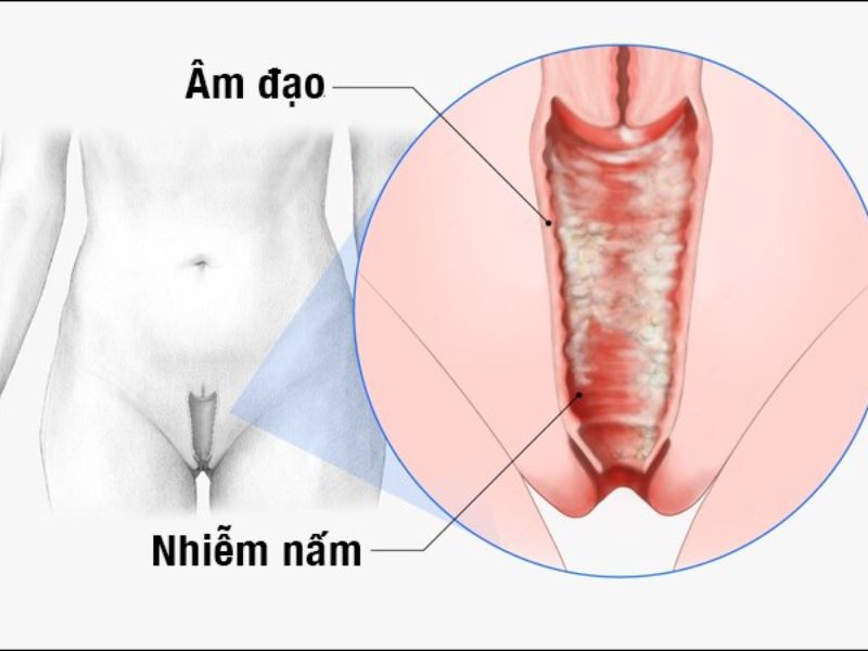 Sau khi đặt thuốc phụ khoa bao lâu thì quan hệ được? Bác sĩ nói gì Viêm âm đạo do nấm thường phải kiêng quan hệ lâu hơn