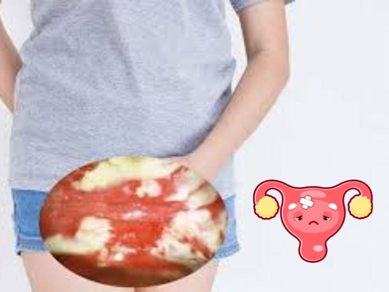 Top 3 dấu hiệu bị nấm có ảnh hưởng đến kinh nguyệt - Đọc ngay! 4
