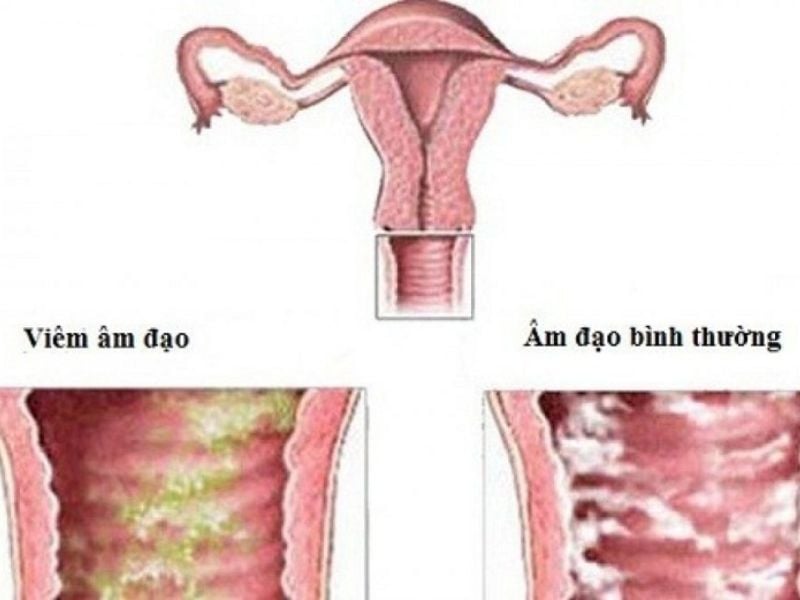 Top 3 dấu hiệu bị nấm có ảnh hưởng đến kinh nguyệt - Đọc ngay! bị nấm candida có gây trễ kinh không