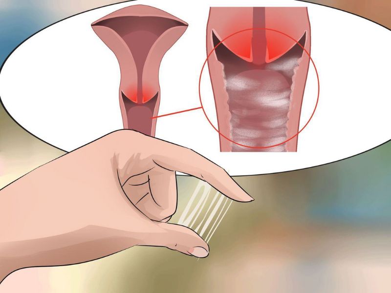 Viêm nhiễm phụ khoa
