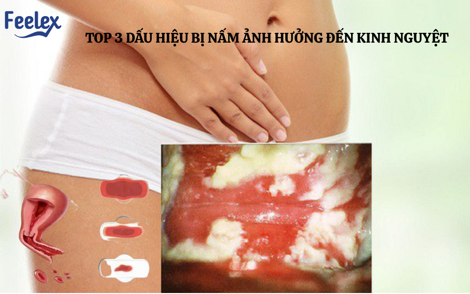 bị nấm có ảnh hưởng đến kinh nguyệt